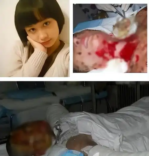 16岁女孩因拒绝男生追求,被泼汽油容貌尽毁,后来她过得如何了
