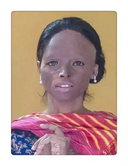 这些印度美女被泼硫酸毁容后,没有自杀,依然美丽的活着