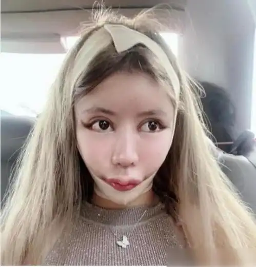 女孩13岁整容60次,砸100万整成芭比娃娃,如今脸难以言语