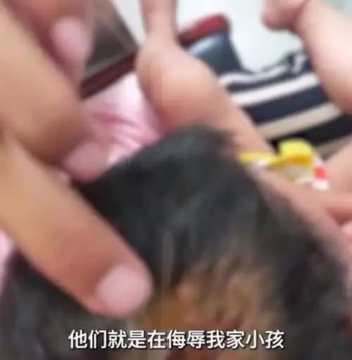 怒女子遛狗不拴绳咬伤女童头部,女童爸爸打倒狗警方女子不承认狗咬人,还要狗的医药费腾讯新闻