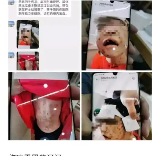 黑龙江遭虐待4岁女童已能喝营养液,继母和生父被批捕,生母已筹集7万善款