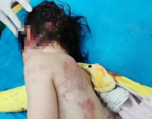 4岁女童被大狗咬得遍体鳞伤,外婆为救人骨折,狗主人迟迟未现身