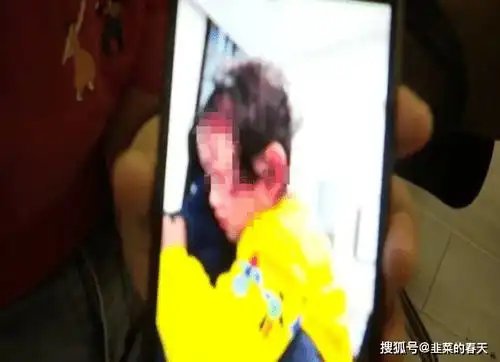 女童被狗咬的遍体鳞伤,狗主人却不见了,网友遛狗不栓狗