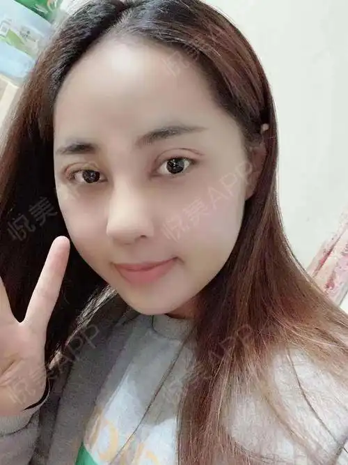 现在这个社会,对女孩子的要求总是那么的高,不仅要有...鼻部多项悦美整形