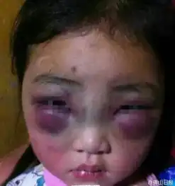 网曝女童遭父母殴打虐待双眼浮肿惨不忍睹组图